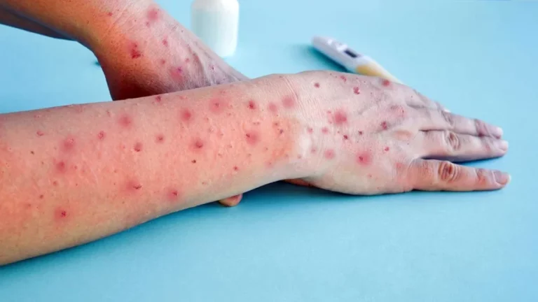 El primer caso autóctono de viruela símica del país es bonaerense